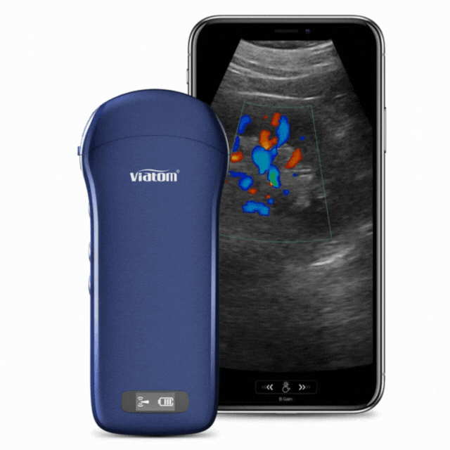 viatom-3in1-hordozható ultrahang-640x640-2
